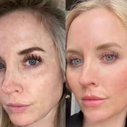 Ultra Glow- Skin Resurfacing at Rise iV & Beauty Bar in New Braunfels, TX