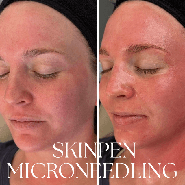 SkinPen series at Rise iV & Beauty Bar in New Braunfels, TX