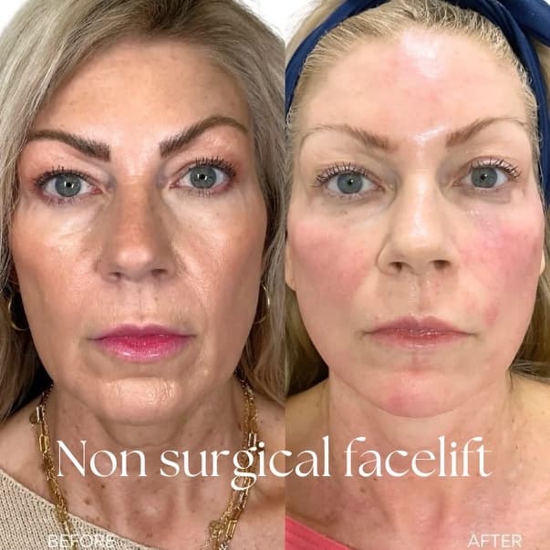 XERF-Skin Tightening at Rise iV & Beauty Bar in New Braunfels, TX